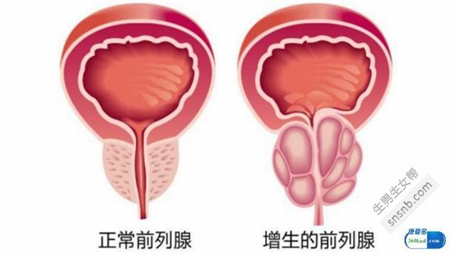 盐酸坦索罗辛缓释胶囊在治疗前列腺增生方面如何发挥作用？